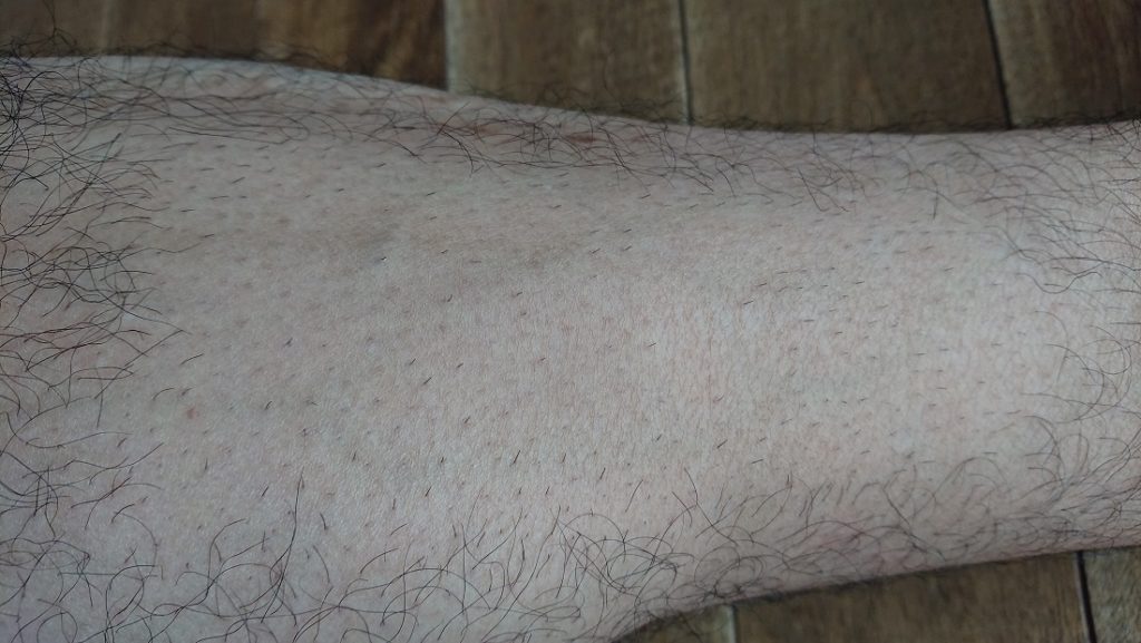 家庭用レーザー脱毛器使用の2週間後の足