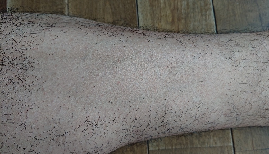 家庭用レーザー脱毛器使用の4週間後の足