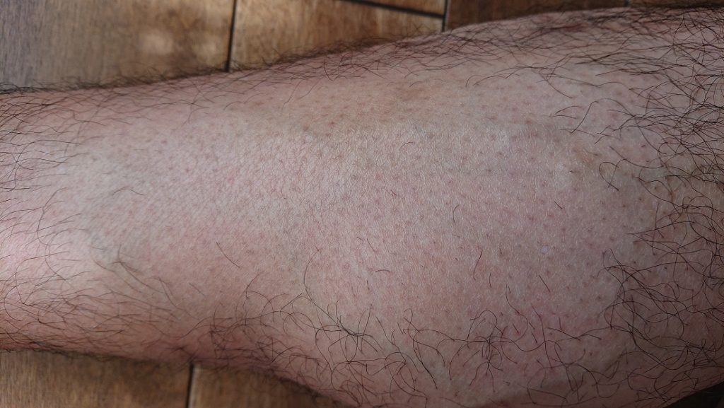 家庭用レーザー脱毛器使用の8週間後の足