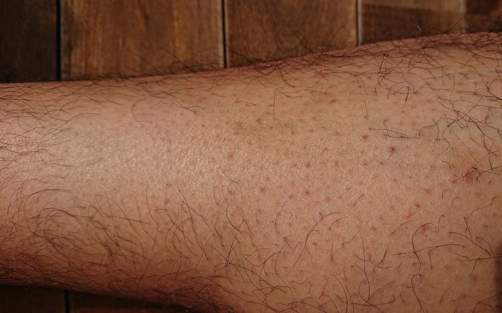 脱毛ラボ レーザー脱毛器使用の5ヶ月後の足